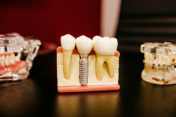 dental implant